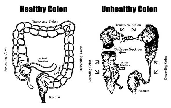 Healthy and Unhealthy Colon